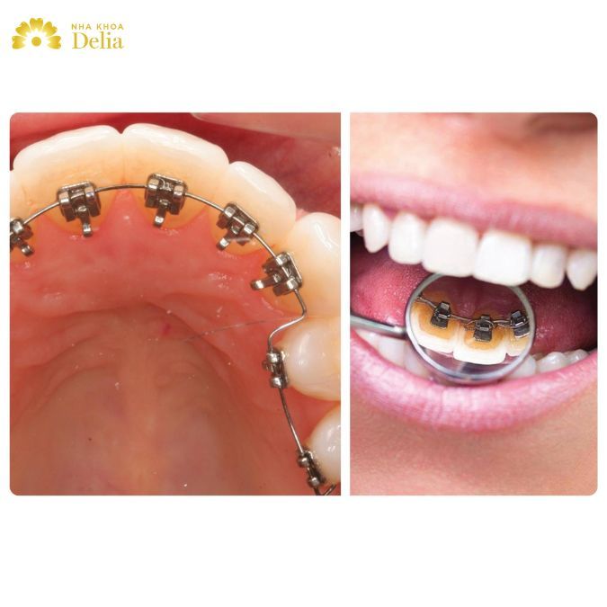 Niềng răng mắc cài mặt trong (niềng răng mắc cài mặt lưỡi) có cấu tạo giống niềng răng mắc cài kim loại