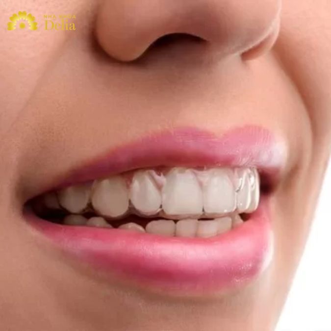 Khi niềng răng bằng khay niềng trong suốt, răng sẽ di chuyển nhờ vào lực tác động lên răng