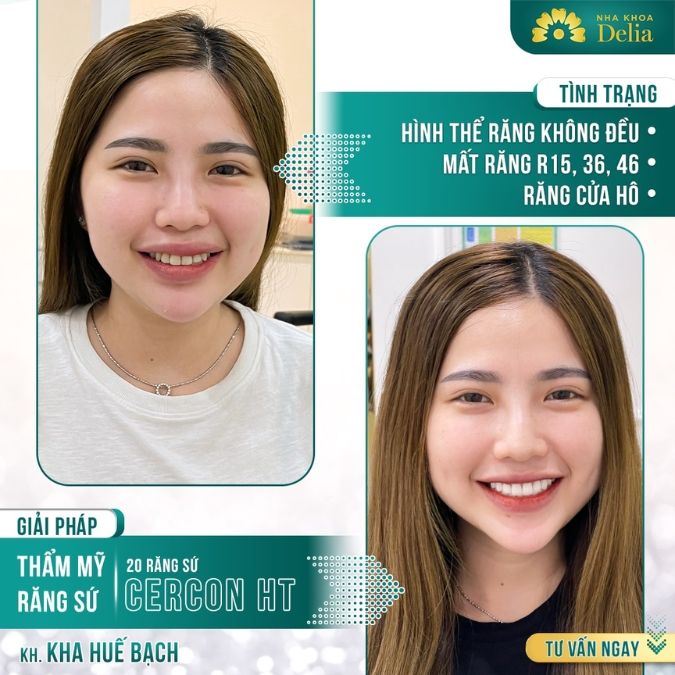 So sánh răng sứ zirconia và cercon