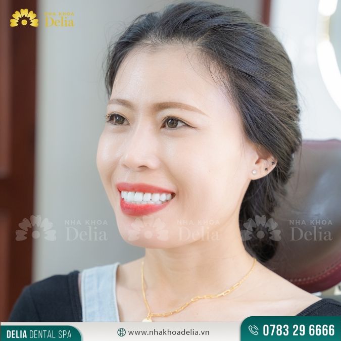 So sánh răng sứ Cercon và Venus