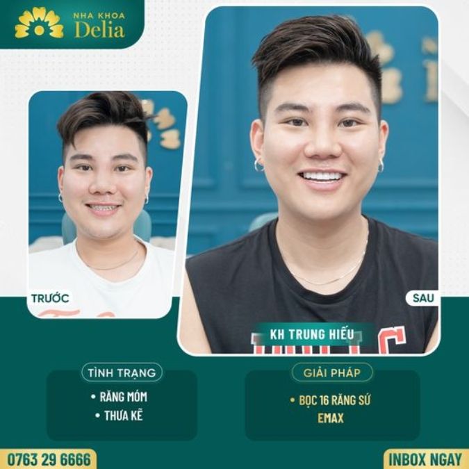 So sánh răng sứ Emax và Cercon