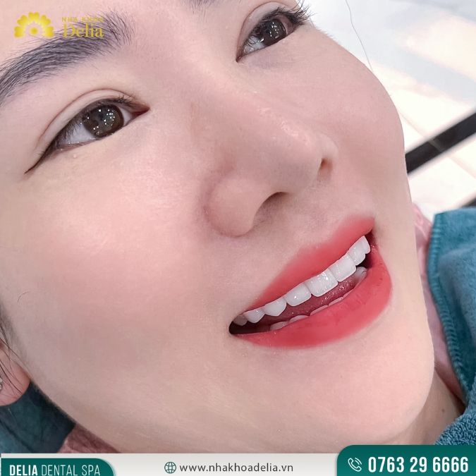 So sánh răng sứ Titan và răng sứ Zirconia