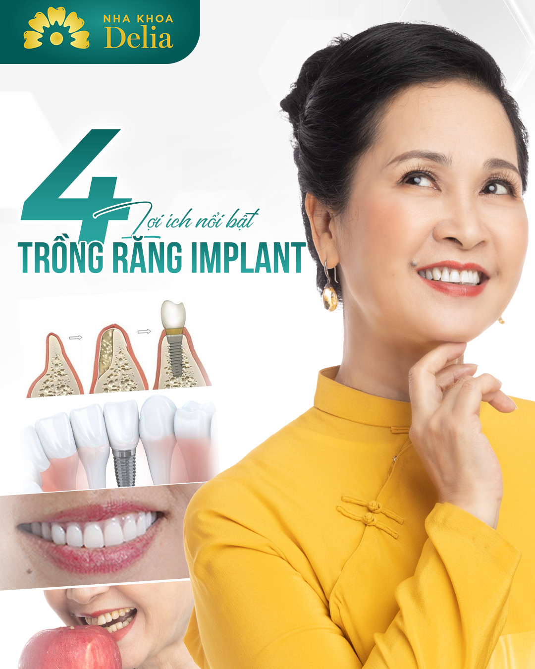 Có Nên Trồng Răng Implant Không? 4 Câu Hỏi Giúp Bạn Dễ Dàng Quyết Định