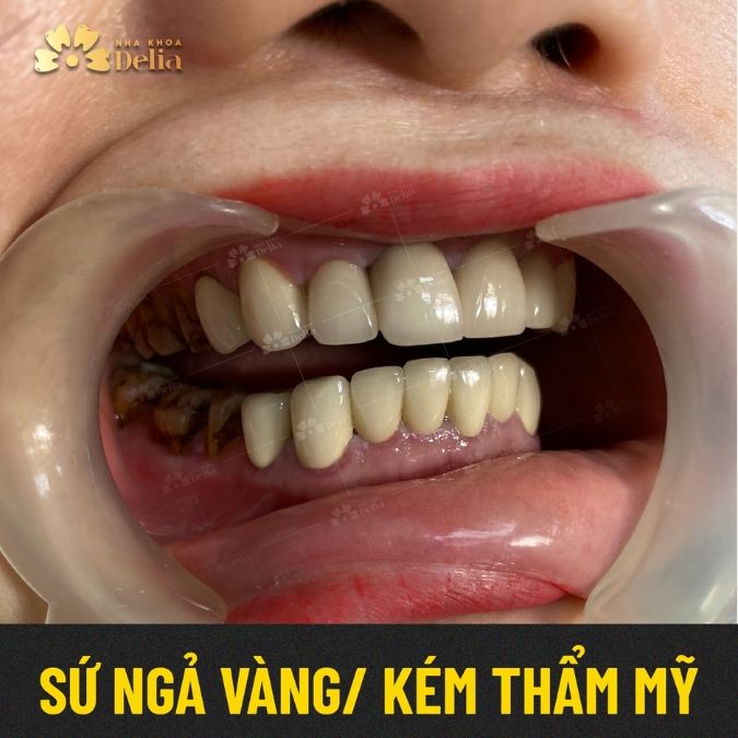 Tại sao không nên sử dụng răng sứ kim loại giá rẻ?