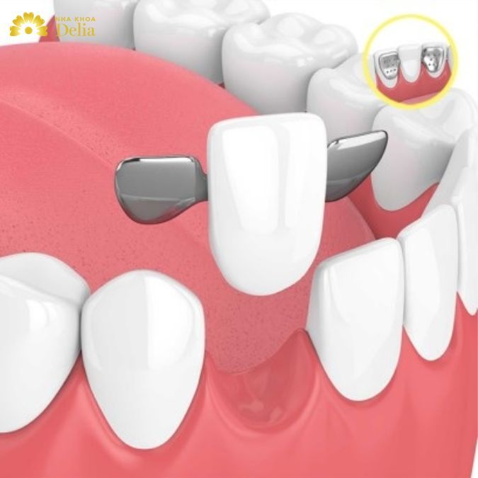 Đây là là cầu răng có khả năng bảo tồn răng thật cao nhất