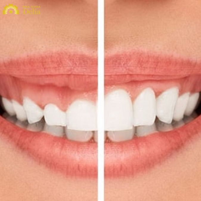 Xương ổ răng quá dày và gồ có thể khiến lợi bị hở khi cười
