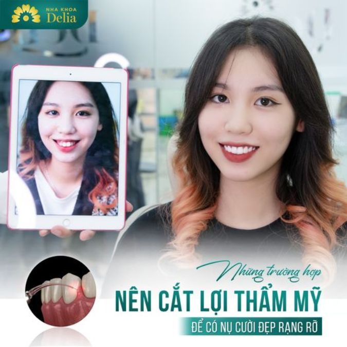 Phẫu thuật cười hở lợi không gây ra cảm giác đau nhức hay khó chịu