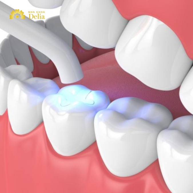 Amalgam là vật liệu trám răng phổ biến được các nha sĩ sử dụng trong hơn 1 thế kỷ qua