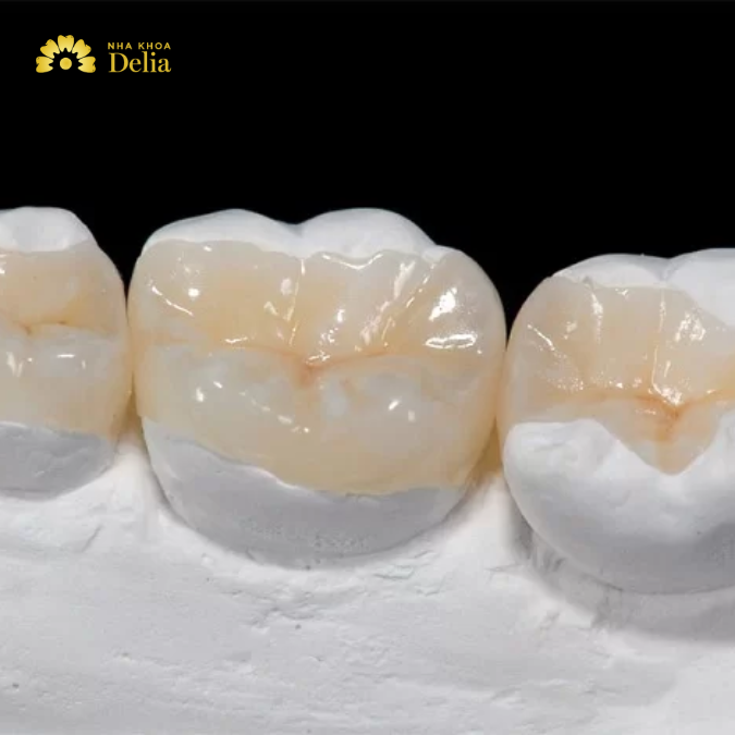 Inlay/ Onlay sứ là loại vật liệu trám răng được chế tác từ sứ nha khoa cao cấp