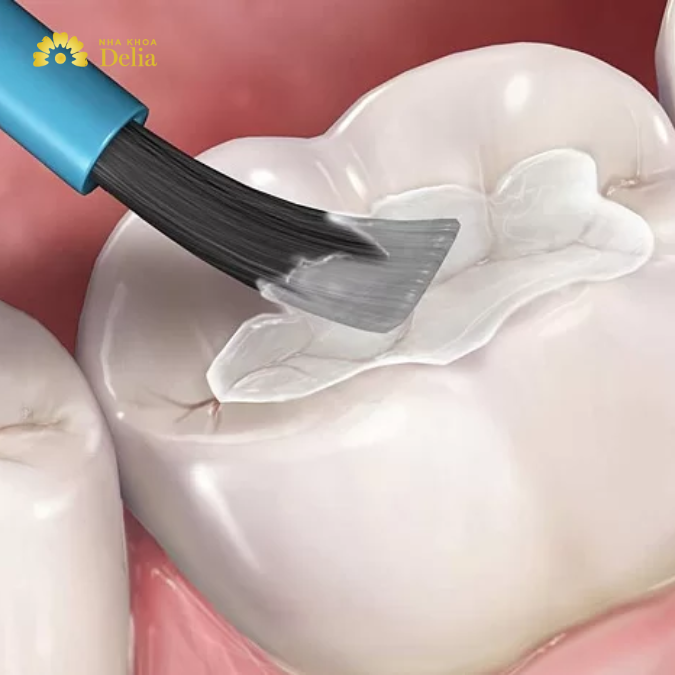 Hàn trám răng là gì? Trường hợp nào nên và không nên hàn trám răng