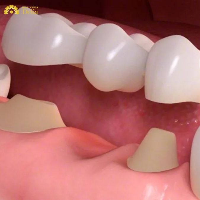 Cầu răng sứ là giải pháp giúp khắc phục răng mất hiệu quả được nhiều người chọn lựa