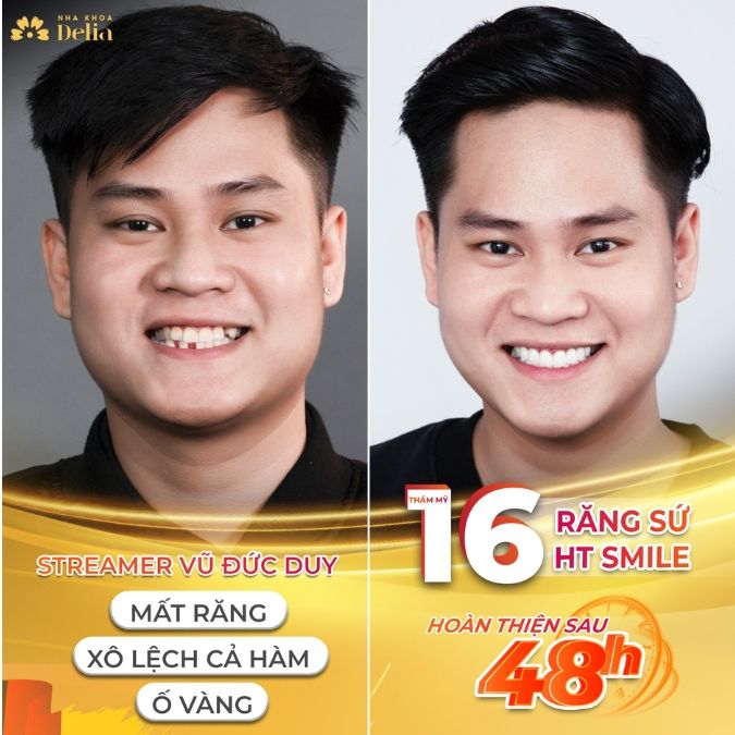 Cầu răng sứ là gì?