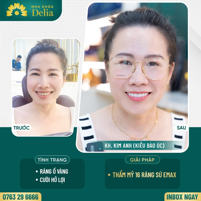Bọc răng sứ điều trị cười hở lợi hiệu quả