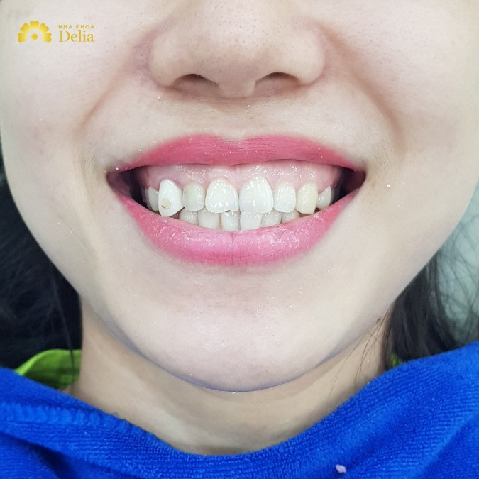 Người cười hở lợi sướng hay khổ