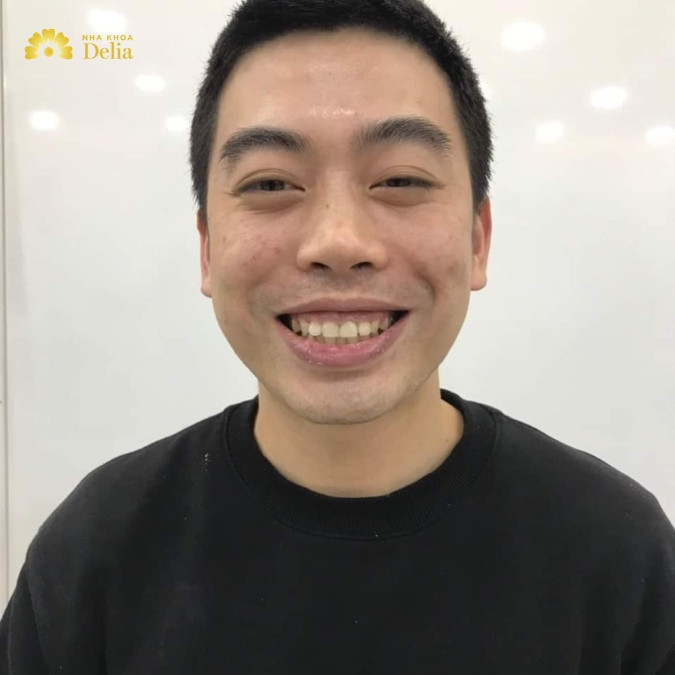 Tướng số đàn ông cười hở lợi