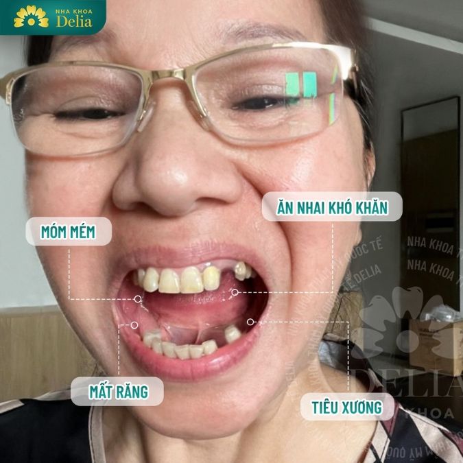 Cấy răng Implant cần lưu ý những gì?