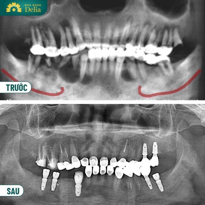 Phương pháp cấy ghép Implant là gì?