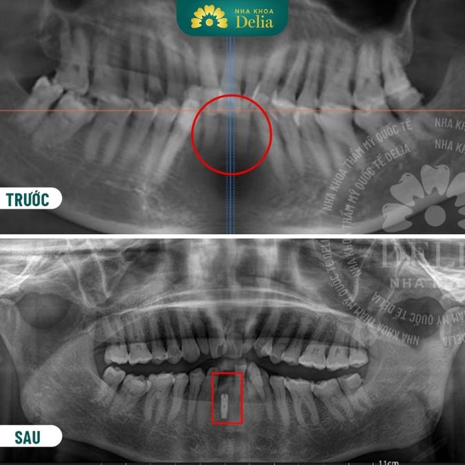 Cấy răng Implant cần lưu ý những gì?