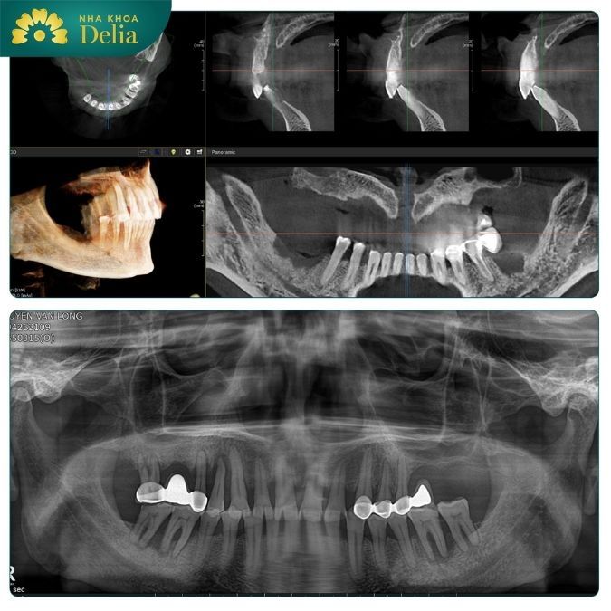 Cấy răng Implant cần lưu ý những gì?