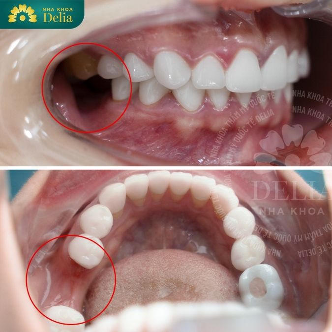 Cấy răng Implant cần lưu ý những gì?