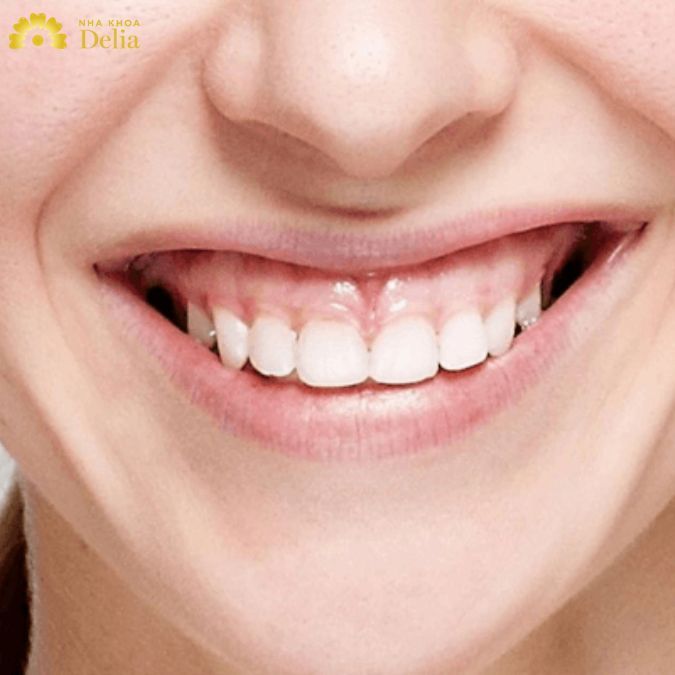 Cười hở lợi là khoảng cách từ cổ răng đến vành môi trên 3mm