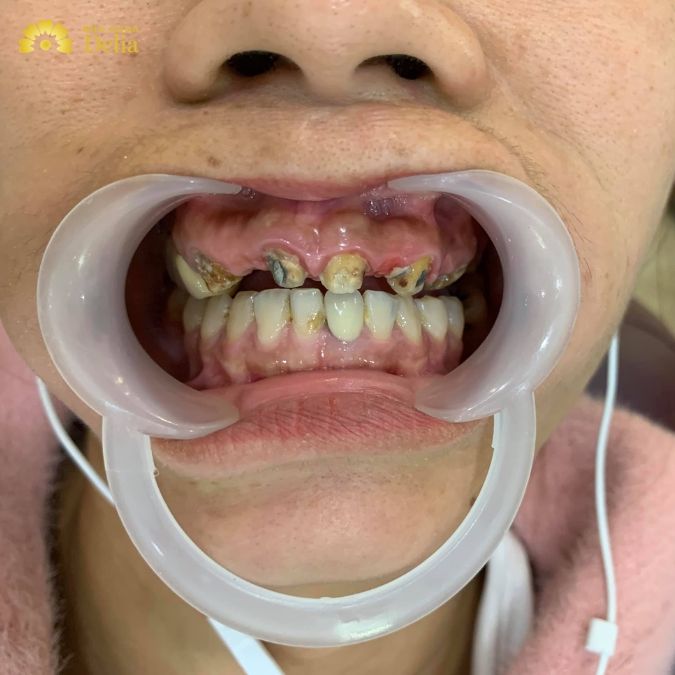Răng bị sâu phải làm sao? Có bắt buộc phải nhổ răng sâu không?
