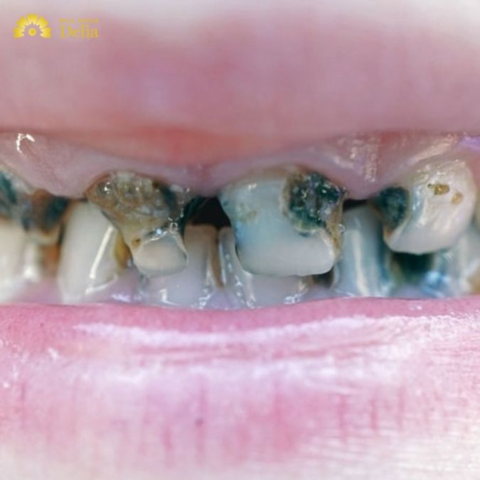 Những dấu hiệu nhận biết răng bị sâu nặng