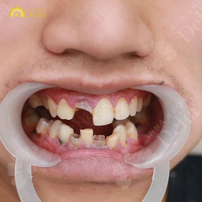 Chức năng của răng cửa?