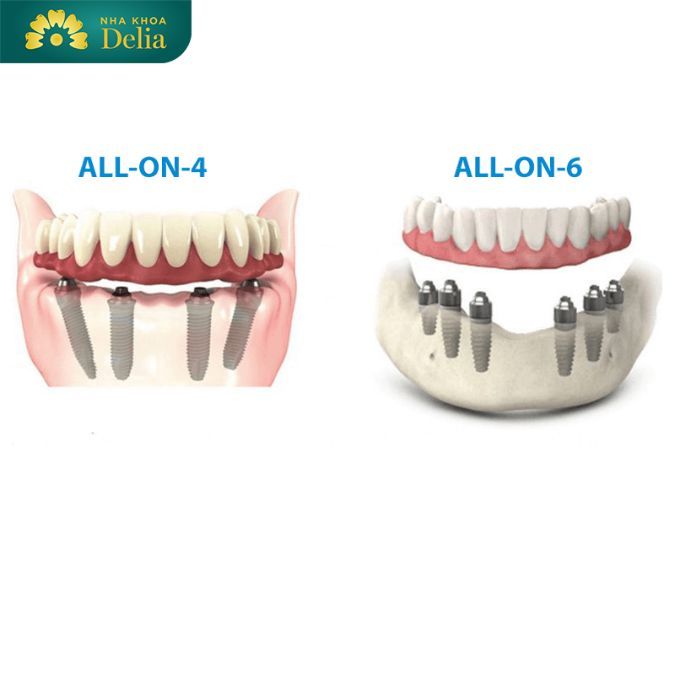 Trồng răng Implant nguyên hàm All on 4, All on 6 là hai kỹ thuật trồng răng bị mất toàn hàm tối ưu
