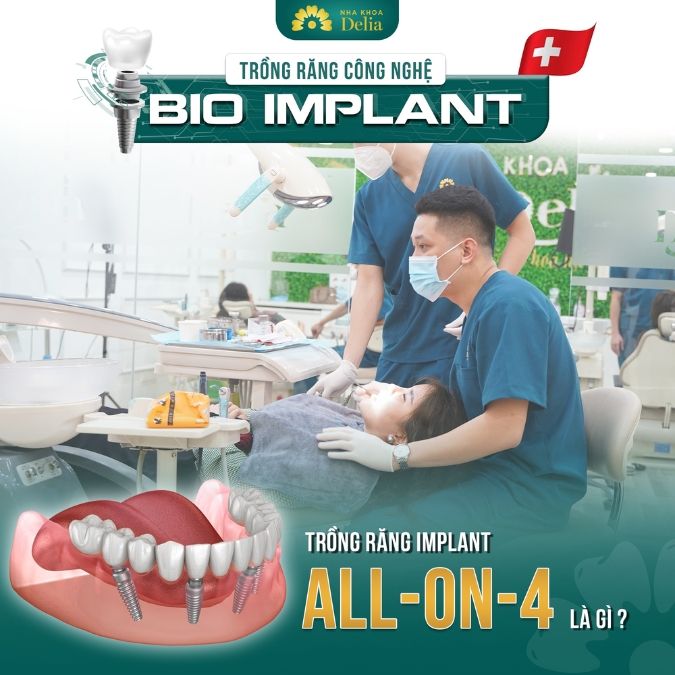 Trồng răng Implant All on 4