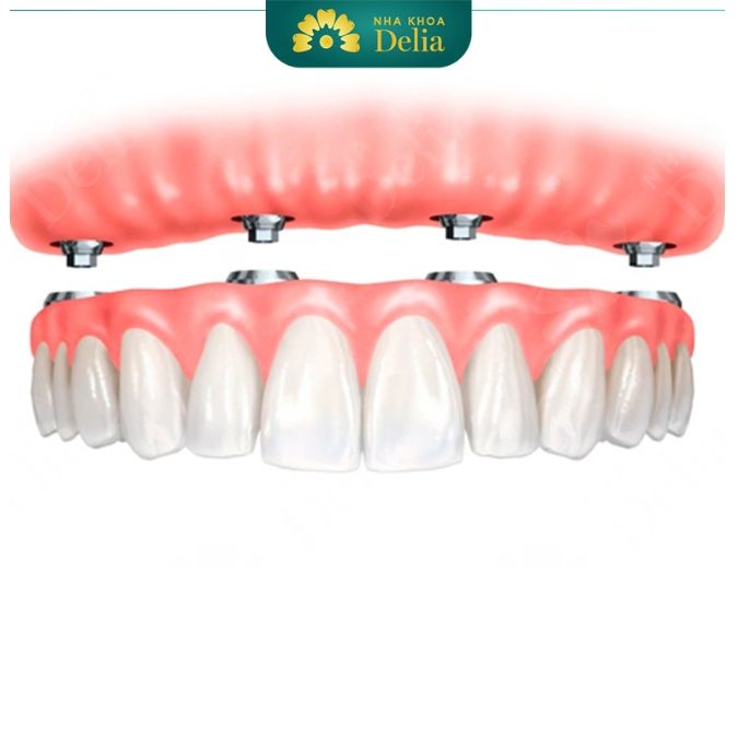 Trồng răng Implant All on 4 áp dụng cho trường hợp nào? 