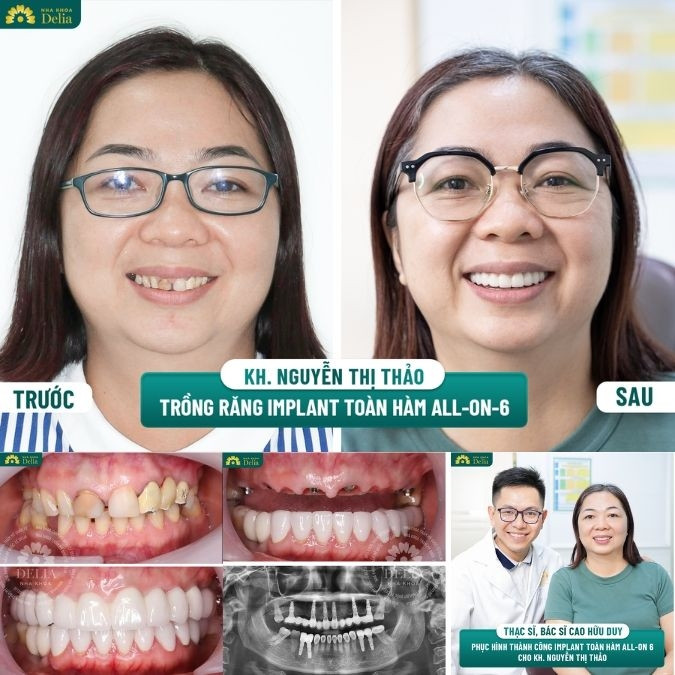 Trồng răng Implant ALL ON 6 là gì?