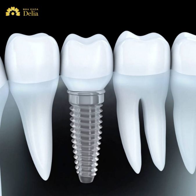 Cầu răng trên Implant 