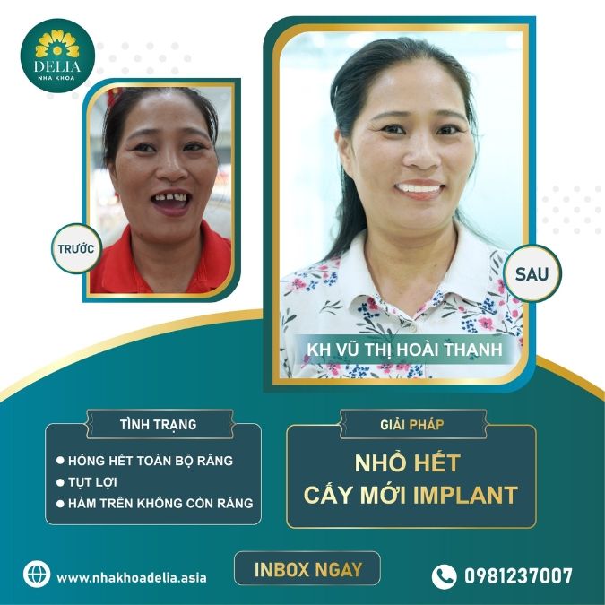 Trồng răng Implant Hàn Quốc có tốt không?