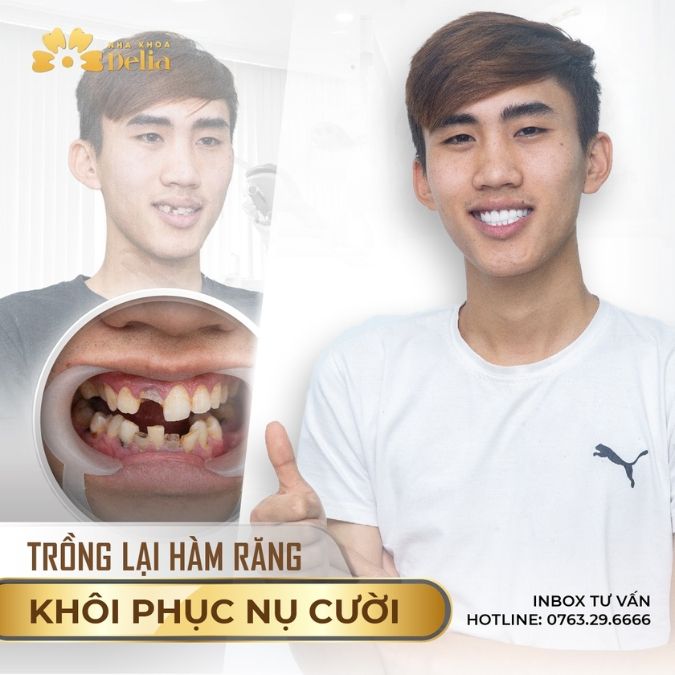 Trồng răng Implant Hàn Quốc có tốt không?