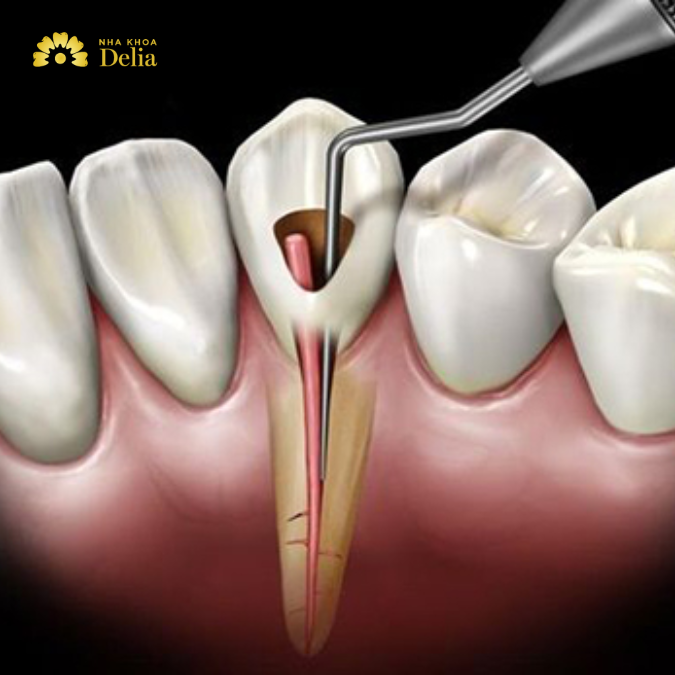 Ở cấp độ 1, viêm tủy răng có thể được điều trị dễ dàng bằng cách khắc phục nguyên nhân
