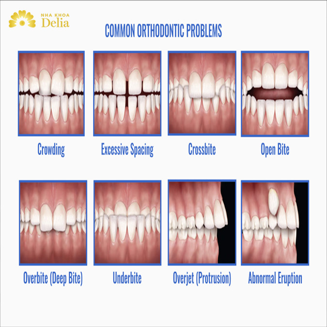 8 kiểu răng hô phổ biến