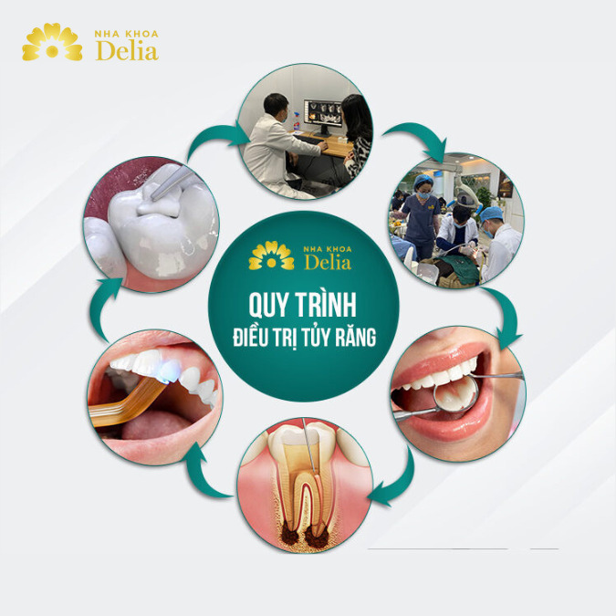 Quy trình điều trị tủy răng từ A – Z chuẩn quốc tế tại nha khoa Delia