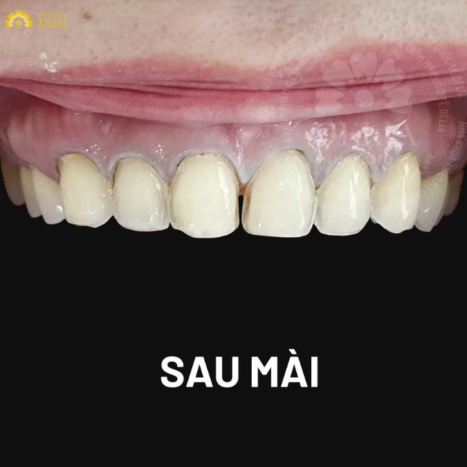 Đối với phương pháp bọc răng sứ kỹ thuật của nha sĩ là rất quan trọng đòi hỏi nha sĩ phải có tay nghề chuyên môn cao