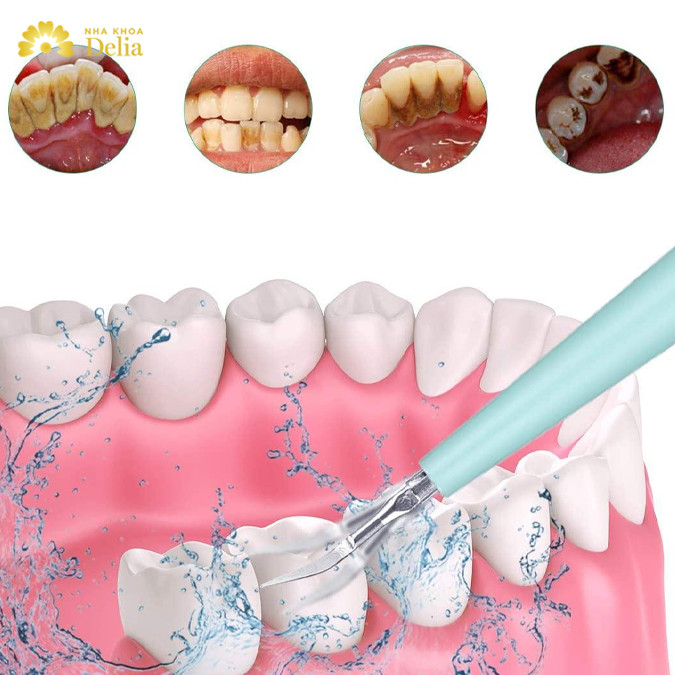 Cạo vôi răng bằng máy nước được áp dụng phổ biến tại nhiều nha khoa