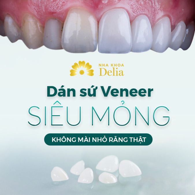 Bọc răng sứ không mai nhỏ hay còn gọi là dán sứ veneer