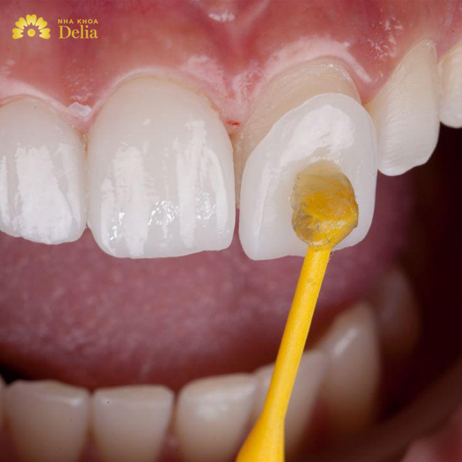 Đắp răng sứ là bước sử dụng keo y khóa gắn sứ lên bề mặt răng thật