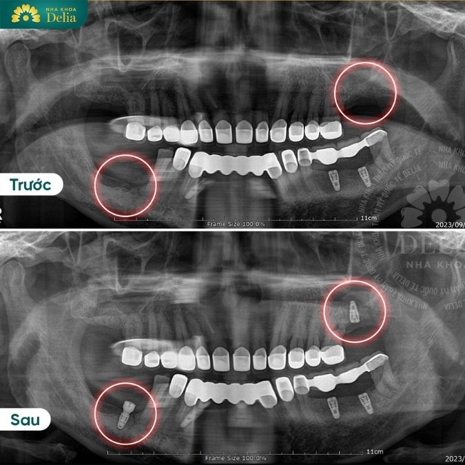Điều kiện để trồng răng Implant