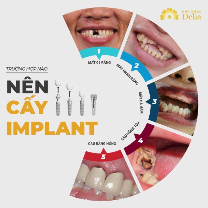 Trường hợp nào nên cấy ghép răng Implant?
