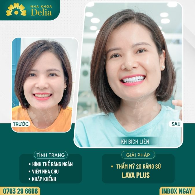 Biện pháp khắc phục tình trạng bọc răng sứ hôi miệng