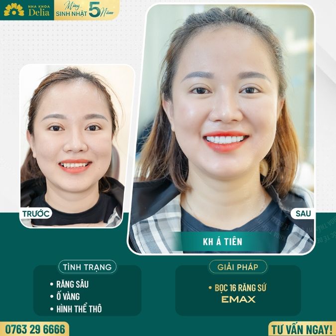 Sứ chất lượng cam kết không gặp phải tình trạng gắn răng sứ bị hôi