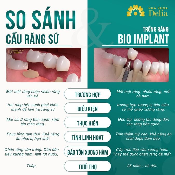 So sánh phương pháp cầu răng sứ và cấy ghép Implant