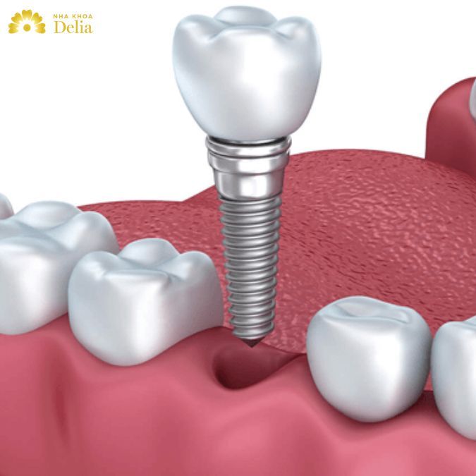 Implant được thiết kế chắc chắn, giúp nâng đỡ răng sứ, cầu răng