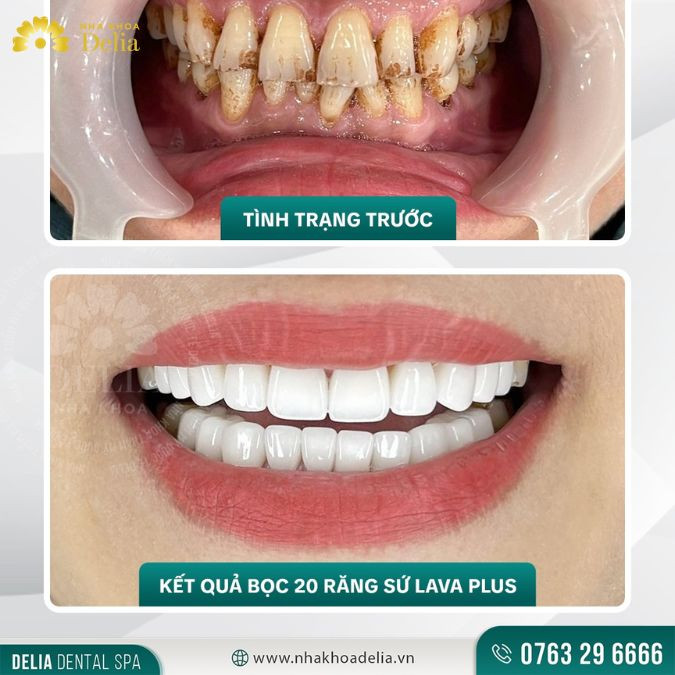 Làm răng sứ ở địa chỉ nha khoa thiếu uy tín có thể dẫn tới hôi miệng