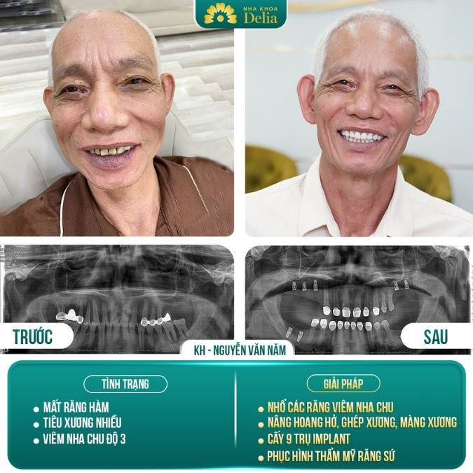 Chú Năm chia sẻ:"Biết trồng răng Implant không đau như này thì tôi đã làm từ lâu rồi"